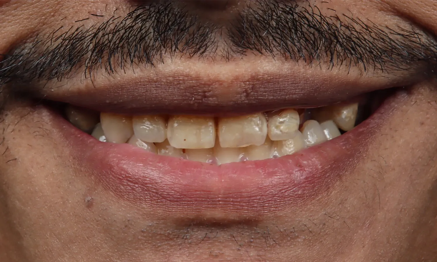 قبل — هوليود سمايل