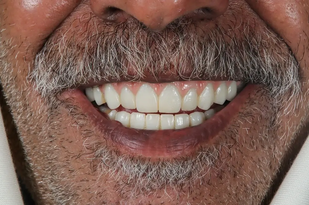 بعد — زراعة الأسنان