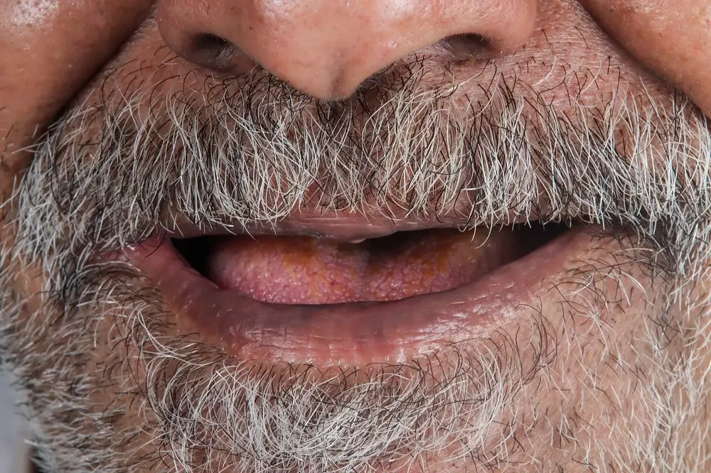 قبل — زراعة الأسنان